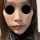 ヒアルロン酸注入（頬） ルラ美容クリニック 仙台院 / ルラスキンクリニック 仙台院 BEFORE サムネイル用