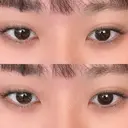 ヒアルロン酸注入（涙袋） / ボトックス（エラ・小顔） フィラークリニック 大阪心斎橋院 BEFORE サムネイル用