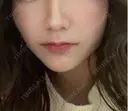 ヒアルロン酸注入（涙袋） / ヒアルロン酸注入（唇） アネシス美容クリニック BEFORE サムネイル用