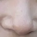 ピーリング（ハリ・ツヤ） Lumiera Clinic BEFORE サムネイル用