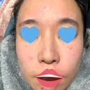 ダーマペン / PRP皮膚再生療法 / ヴァンパイアフェイシャル 筋肉・美容クリニック BEFORE サムネイル用