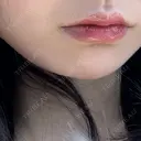 ヒアルロン酸注入（あご） / ボトックス（エラ・小顔） PRO CLINIC プロクリニック 銀座院 BEFORE サムネイル用