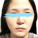小鼻縮小（切開） / 鼻翼基部形成（貴族手術） 新宿ラクル美容外科クリニック 新宿院 BEFORE サムネイル用