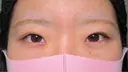 二重埋没 / 目頭切開 HAAB×DREAM BEAUTY CLINIC 大阪梅田院 BEFORE サムネイル用