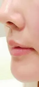 ヒアルロン酸注入（涙袋） / ヒアルロン酸注入（唇） 共立美容外科 梅田院 BEFORE サムネイル用
