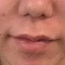 ヒアルロン酸注入（唇） L‘amour clinic Tokyo【ラムールクリニック東京】 BEFORE サムネイル用