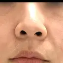 鼻尖形成（切開） / 小鼻縮小（切開） / 軟骨移植 / 鼻柱下降・鼻唇角形成（猫手術） / その他（鼻） 東京シンデレラ美容外科 池袋院 BEFORE サムネイル用