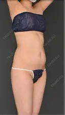 脂肪吸引（お腹） / 脂肪吸引（腰） Lipo Clinic omotesando BEFORE サムネイル用