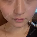 ハイフ（顔） 表参道メディカルクリニック 名古屋院 BEFORE サムネイル用