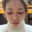 ピコレーザートーニング（美白・肝斑） アマリラビューティークリニック BEFORE サムネイル用