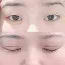 二重埋没 湘南美容クリニック 松山院 BEFORE サムネイル用