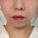 糸リフト / ヒアルロン酸注入（あご） / ボトックス（エラ・小顔） TCB東京中央美容外科 広島院 BEFORE サムネイル用