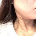 その他（輪郭） ルラ美容クリニック 大宮院 / ルラスキンクリニック 大宮院 BEFORE サムネイル用