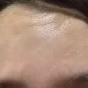 ボトックス（あご） / ボトックス（眉間） / ボトックス（目尻） / ボトックス（額） TCB東京中央美容外科 名古屋栄院 BEFORE サムネイル用