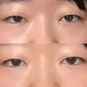 二重埋没 大塚美容形成外科 札幌院 BEFORE サムネイル用