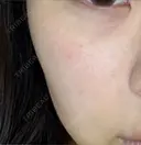 ルメッカ ルラ美容クリニック 渋谷本院 BEFORE サムネイル用