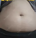 脂肪冷却（二の腕） / 脂肪冷却（お尻） DMTC CLINIC 渋谷院 BEFORE サムネイル用