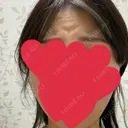 ボトックス（あご） / ボトックス（エラ・小顔） / ボトックス（肩） / ボトックス（眉間） / ボトックス（目尻） / ボトックス（人中） メディカルアルファクリニック BEFORE サムネイル用