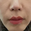 ボトックス（あご） / ボトックス（口角） / ボトックス（眉間） / ボトックス（額） / ボトックス（人中） BiBiクリニック BEFORE サムネイル用