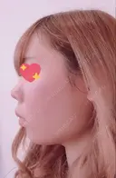 脂肪吸引（顔） / ボトックス（あご） / ボトックス（エラ・小顔） エートップ美容整形外科 BEFORE サムネイル用