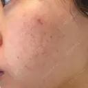 肌育注射（ジュベルックなど） Natural Skin Clinic 自由ヶ丘院 BEFORE サムネイル用