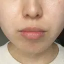 ヒアルロン酸注入（あご） / ヒアルロン酸注入（唇） / ボトックス（口角） フィラークリニック 大阪梅田院 BEFORE サムネイル用