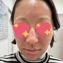 ヴェルヴェットスキン ゆう美容クリニック BEFORE サムネイル用