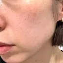 ボトックス（眉間） / 光治療（フォトフェイシャルなど） / ピコスポット Kaleido Clinic（カレイドクリニック） 横浜 BEFORE サムネイル用