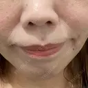 ボトックス（あご） / 肌ヒアルロン酸注入（たるみ・シワ改善） / 高濃度ビタミンC点滴 カジュアルクリニック 平塚院 BEFORE サムネイル用