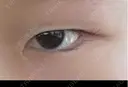 二重埋没 / 目頭切開 かめい美容クリニック宇都宮 BEFORE サムネイル用