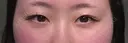 二重埋没 HAAB×DREAM BEAUTY CLINIC 大阪梅田院 BEFORE サムネイル用