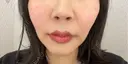 脂肪溶解注射（顔） AZ BEAUTY CLINIC BEFORE サムネイル用