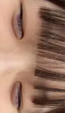 ヒアルロン酸注入（涙袋） 共立美容外科 梅田院 BEFORE サムネイル用