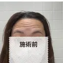 ボトックス（額） アネシス美容クリニック BEFORE サムネイル用