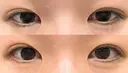 目頭切開 くさのたろうクリニック BEFORE サムネイル用
