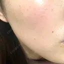ピーリング（ハリ・ツヤ） / ルメッカ 大美会クリニック 梅田院 BEFORE サムネイル用