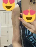 脂肪吸引（二の腕） Lipo Clinic omotesando BEFORE サムネイル用