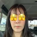 肌ヒアルロン酸注入（たるみ・シワ改善） TCB東京中央美容外科 姫路院 BEFORE サムネイル用