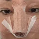 隆鼻術 / 鼻尖形成（切開） / 小鼻縮小（切開） / 軟骨移植 / プロテーゼ除去 / 鼻柱下降・鼻唇角形成（猫手術） ASTRA BEAUTY CLINIC BEFORE サムネイル用
