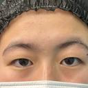 二重埋没 湘南美容クリニック 千葉センシティ院 BEFORE サムネイル用