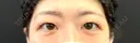 二重埋没 湘南美容クリニック 千葉センシティ院 BEFORE サムネイル用