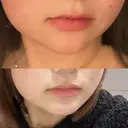 ボトックス（エラ・小顔） / ボトックス（口角） フォンタナクリニック天神 BEFORE サムネイル用