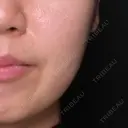 ボトックス（あご） / ボトックス（エラ・小顔） Zetith Beauty Clinic 福岡院 BEFORE サムネイル用