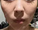 ヒアルロン酸注入（唇） / ボトックス（口角） / スネコス / ポテンツァ ルラ美容クリニック 札幌本院 BEFORE サムネイル用