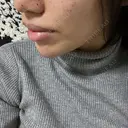 ヒアルロン酸注入（頬） / リジュラン 新宿Ladies&Gentlemen美容クリニック BEFORE サムネイル用