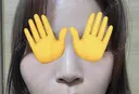 小鼻縮小（切開） / その他（鼻） EMMO FACE CLINIC 東京三田院 BEFORE サムネイル用