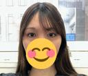 ヒアルロン酸注入（涙袋） 共立美容外科 京都院 BEFORE サムネイル用