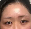 その他（目元） 麻布十番クレールデンタルクリニック BEFORE サムネイル用