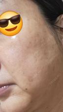 水光注射（ハリ・美肌） しんゆり美容健康クリニック BEFORE サムネイル用