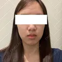 ルビーレーザー 日本美容・医療クリニック 六本木院 BEFORE サムネイル用